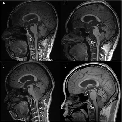 Management of Posterior Fossa Tumors in Adults Based on the Predictors of Postoperative Hydrocephalus